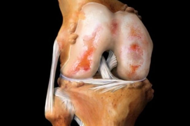 cartilage damage in osteoarthritis of the knee