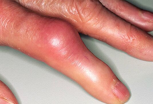 Gout is accompanied by sharp pain in the fingers and swelling in the joints. 