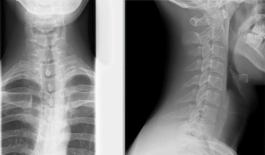 Spinal x-ray is a simple and effective method for diagnosing osteochondrosis