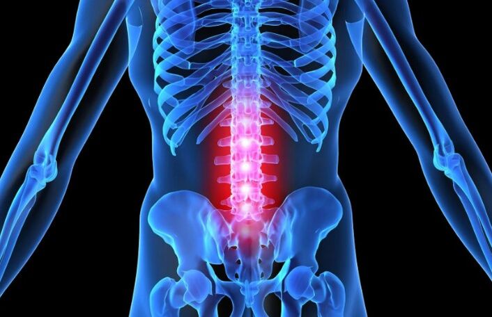 Osteochondrosis in the lumbar region