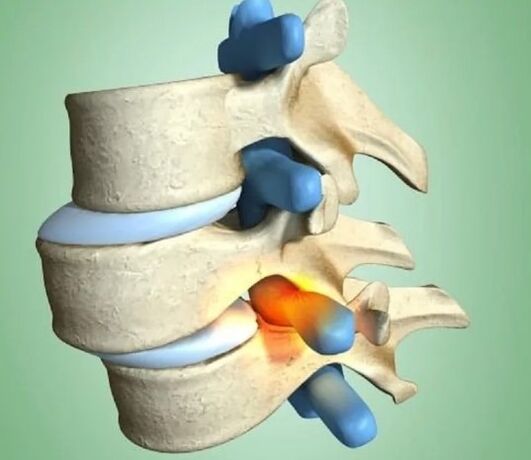 The unstable position of the vertebra