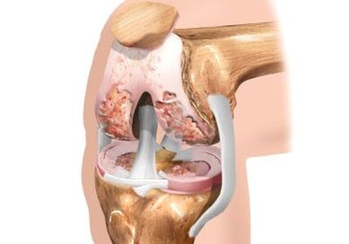 Too bad the joint osteoarthritis of the knee