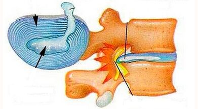 Characteristics of the development of cervical osteochondosis